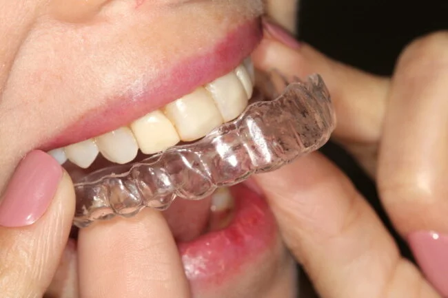Transformação do meu sorriso - Aparelho dentário Invisalign Transformação do meu sorriso - Aparelho dentário Invisalign
