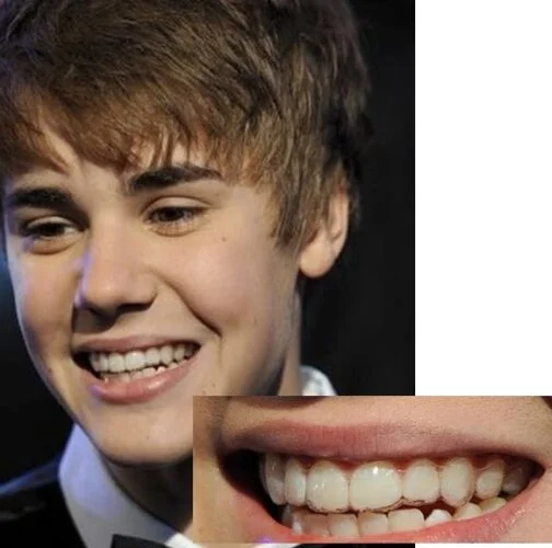 invisalign-justin-bieber invisalign-justin-bieber
