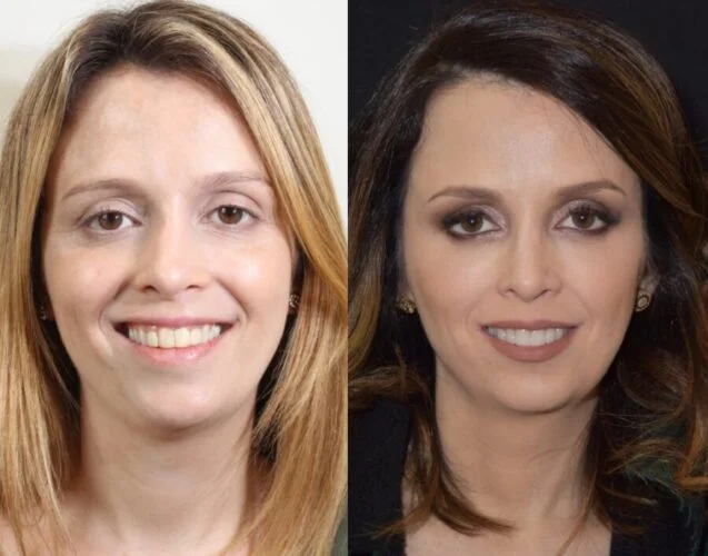 harmonização facial